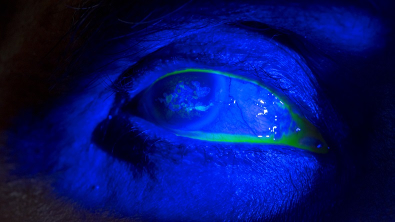 close up of band keratopathy during eye examination. in dark room.