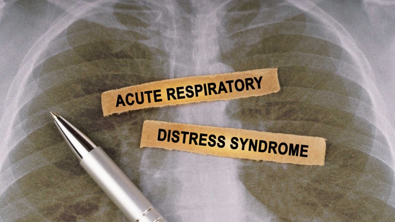 Medical concept. On a human chest x-ray, a pen and strips of paper labeled - Acute respiratory distress syndrome