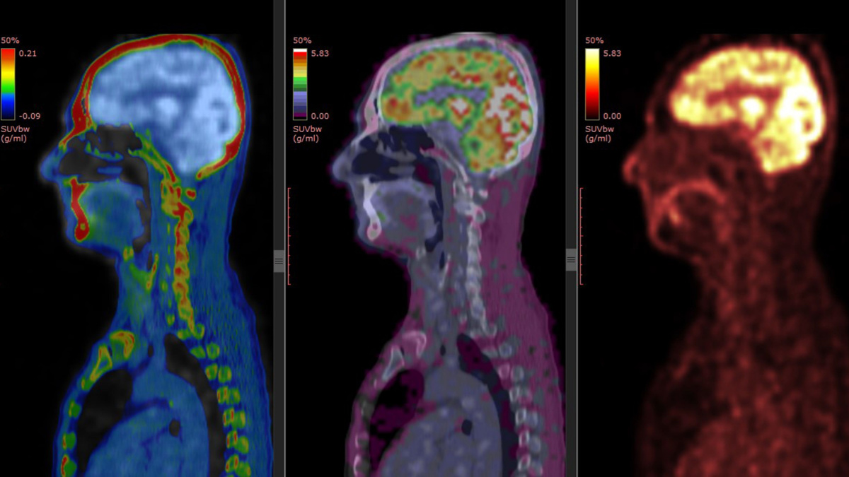 New Alzheimer’s Drug Access Should Ease Somewhat Under Updated Medicare