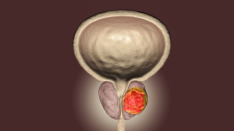 Prostate cancer, 3D illustration showing presence of tumor inside prostate gland which compresses urethra