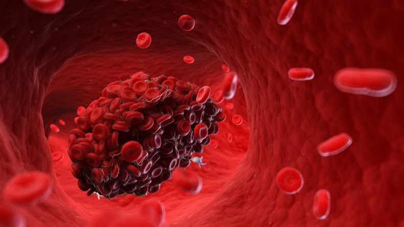 image of a blood clot 