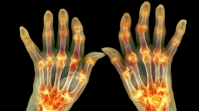 rheumatoid arthritis x-ray image