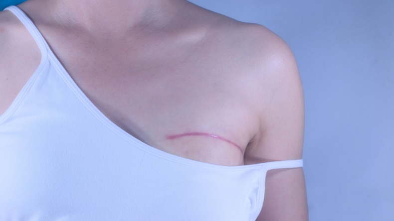 close up of person with breast surgery scar 