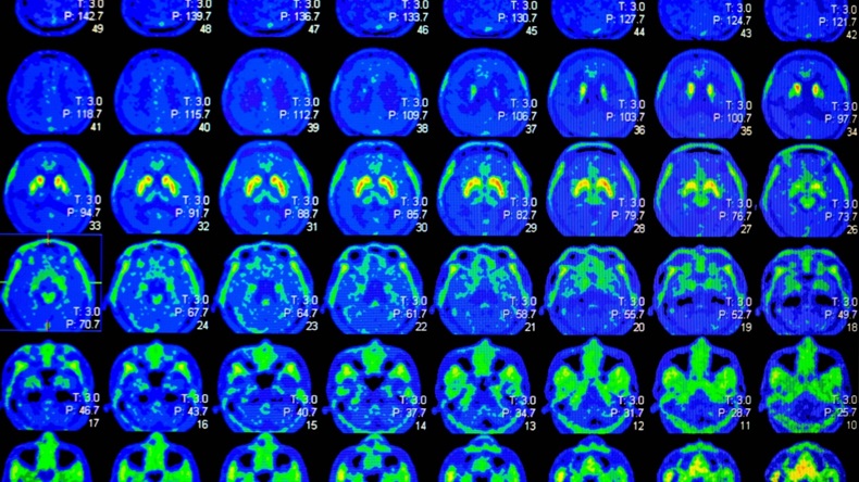 PET scan images of the human brain 