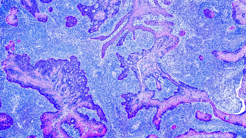 Bladder-cancer-cells