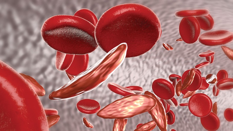 Sickle cell anemia, 3D illustration showing blood vessel with normal and deformated crescent-like red blood cells