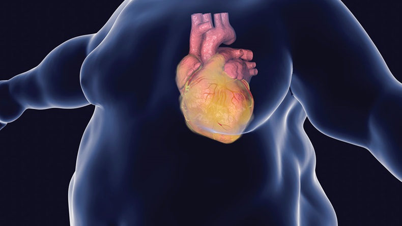 Heart disease in a person with obesity, conceptual image. 3D illustration showing increased weight male with obese heart